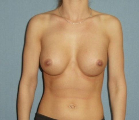 Breast Augmentation Before And After Patient 34