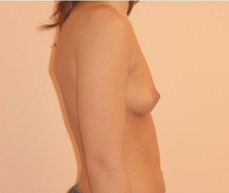 Breast Augmentation Before And After Photo