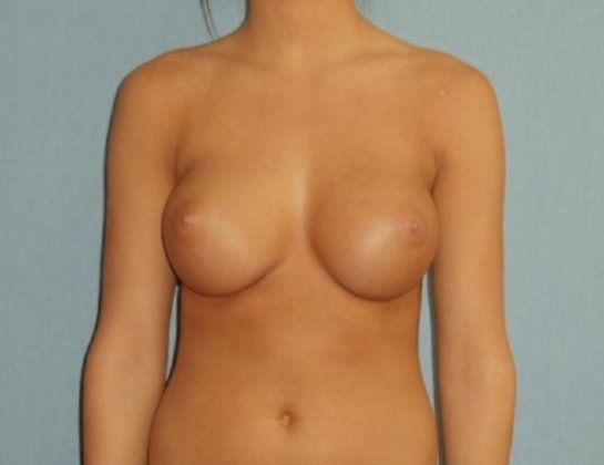 Breast Augmentation Before And After Patient 35