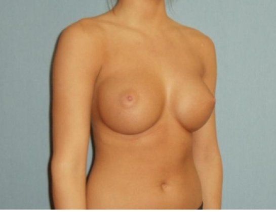 Breast Augmentation Before And After Photo