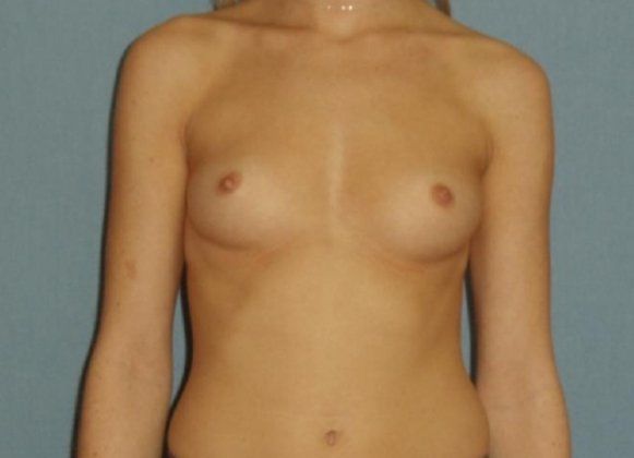 Breast Augmentation Before And After Photo