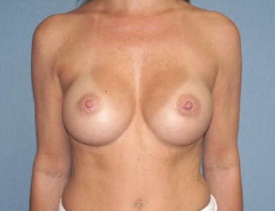 Breast Augmentation Before And After Patient 36