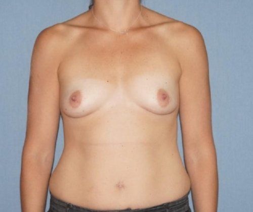 Breast Augmentation Before And After Photo