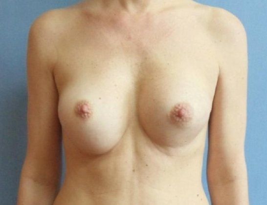 Breast Augmentation Before And After Photo