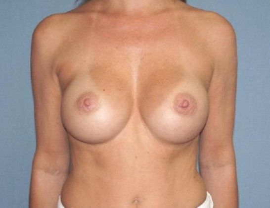 Breast Augmentation Before And After Patient 40