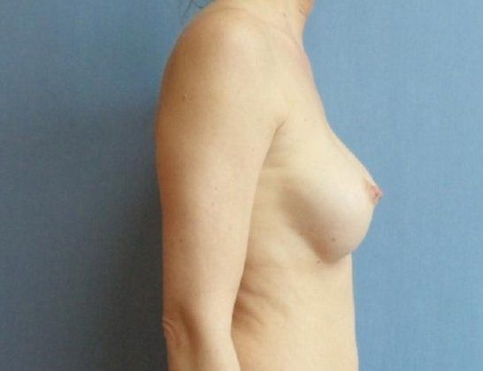 Breast Augmentation Before And After Photo