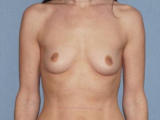 Breast Augmentation Before And After Photo