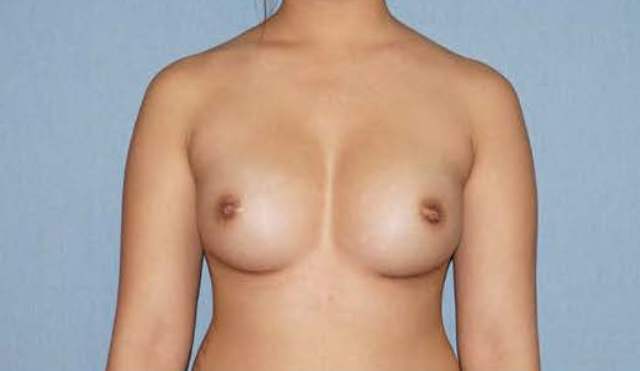 Breast Augmentation Before And After Patient 41