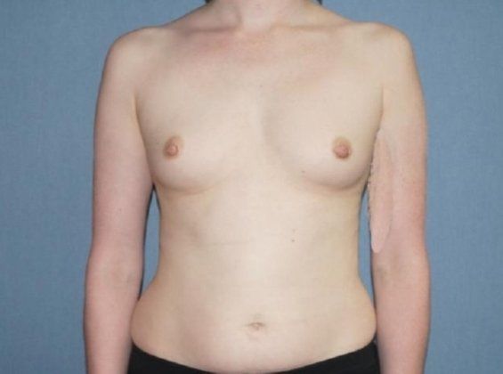 Breast Augmentation Before And After Photo