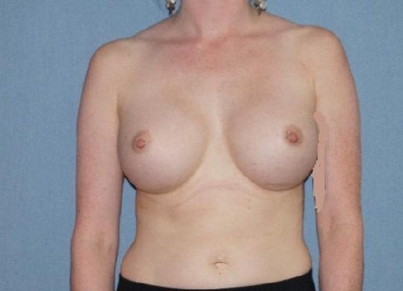 Breast Augmentation Before And After Patient 42