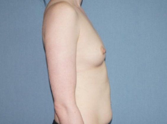 Breast Augmentation Before And After Photo