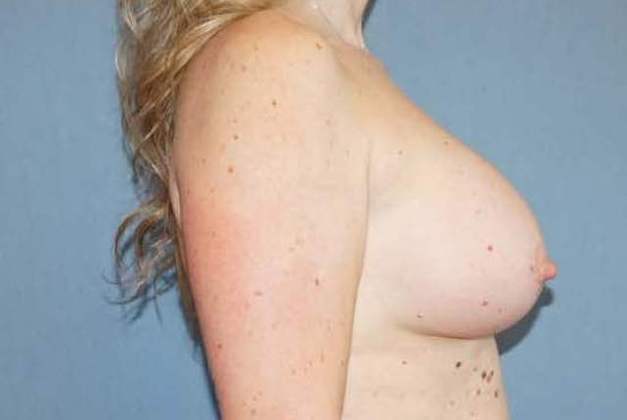 Breast Augmentation Before And After Photo