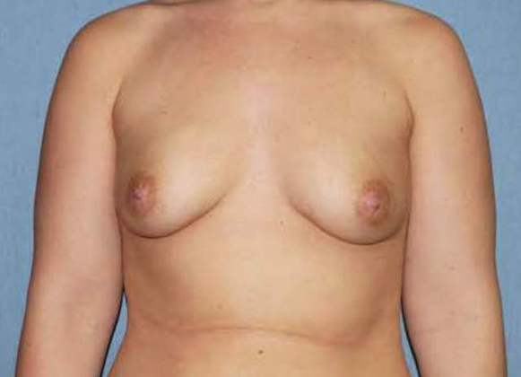 Breast Augmentation Before And After Photo