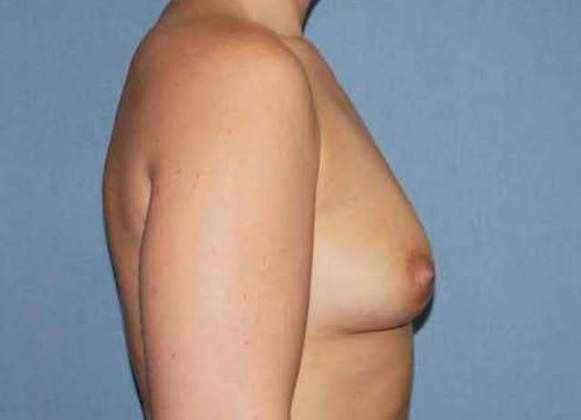 Breast Augmentation Before And After Photo