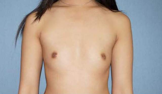 Breast Augmentation Before And After Photo