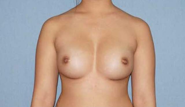 Breast Augmentation Before And After Patient 45