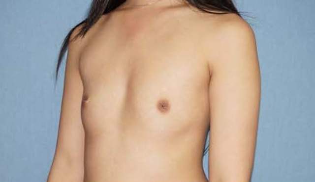 Breast Augmentation Before And After Photo