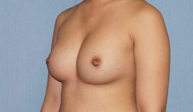 Breast Augmentation Before And After Photo