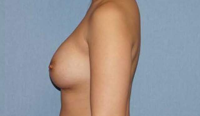 Breast Augmentation Before And After Photo