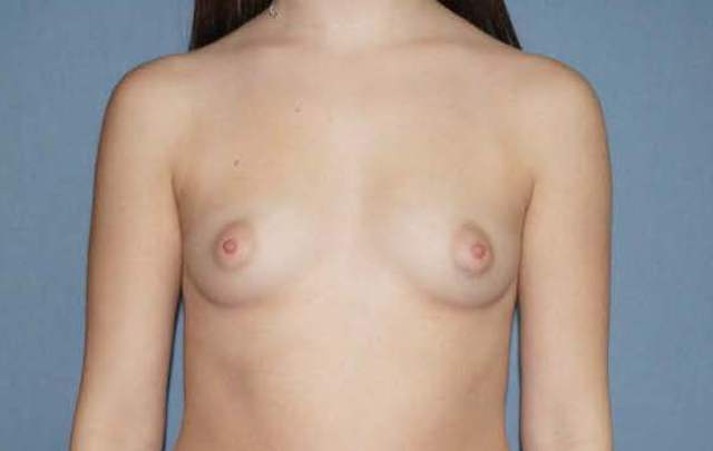 Breast Augmentation Before And After Photo