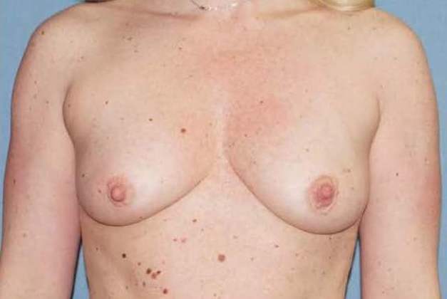 Breast Augmentation Before And After Photo