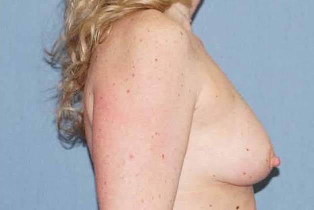 Breast Augmentation Before And After Photo