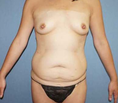 Breast Augmentation Before And After Photo