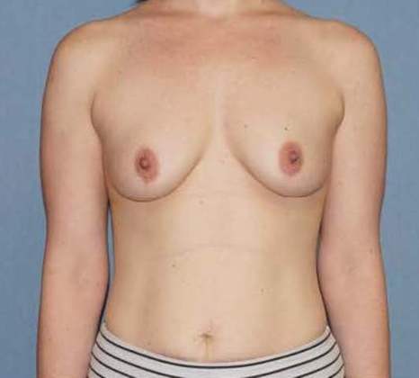 Breast Augmentation Before And After Photo