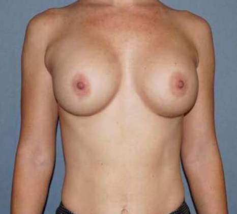 Breast Augmentation Before And After Patient 49