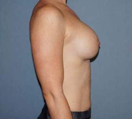 Breast Augmentation Before And After Photo