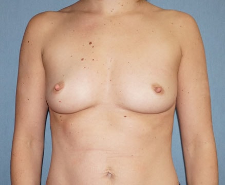 Breast Augmentation Before And After Photo