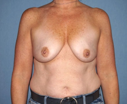 Breast Augmentation Before And After Photo