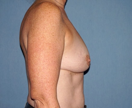 Breast Augmentation Before And After Photo