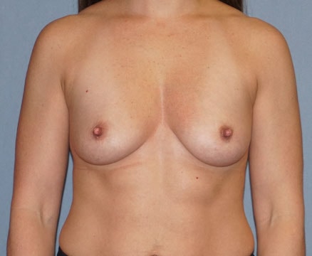 Breast Augmentation Before And After Photo