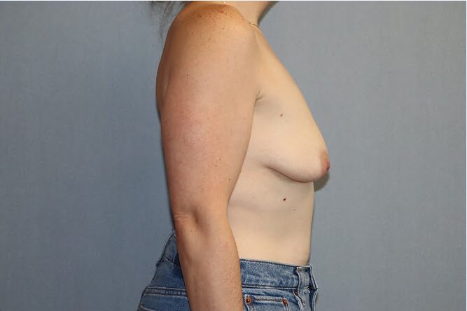 Breast Augmentation Before & After Image