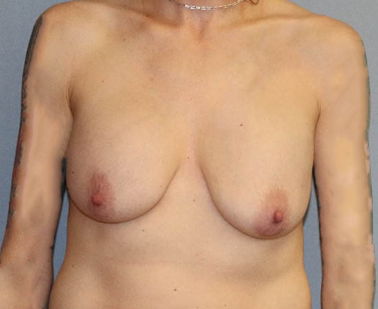 Breast Lift Before And After Photo