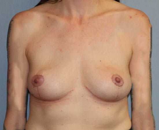 Breast Lift Before And After Photo