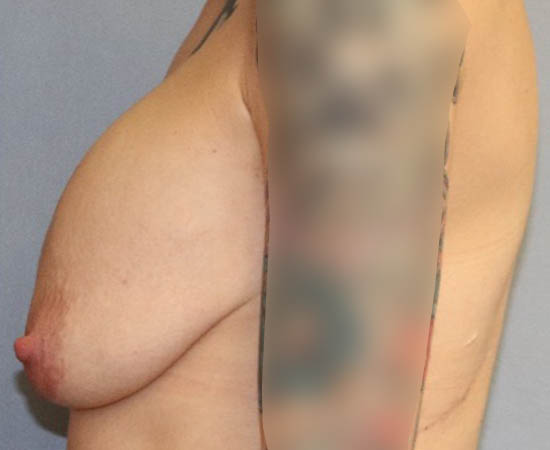 Breast Lift Before And After Photo