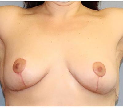 Breast Lift Before And After Patient 2