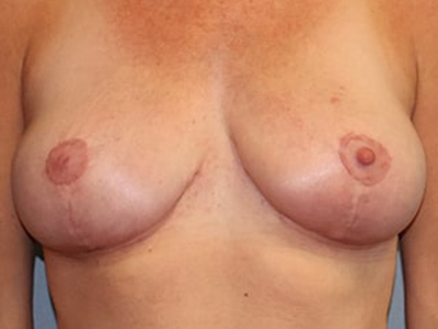 Breast Lift Before And After Patient 4