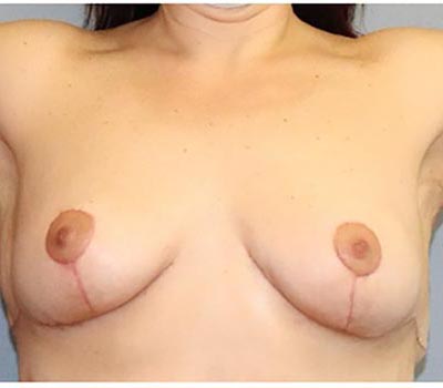 Breast Lift Before And After Photo