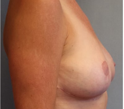 Breast Lift Before And After Photo