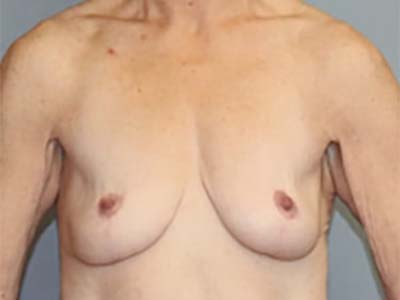 Breast Lift Before And After Patient 8