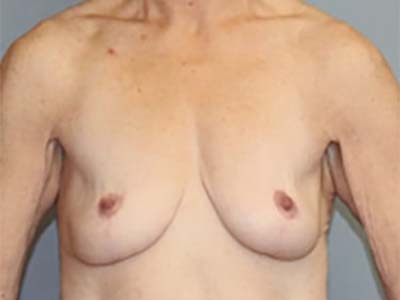 Breast Lift Before & After Image