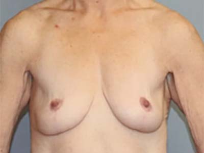 Breast Lift Before And After Photo