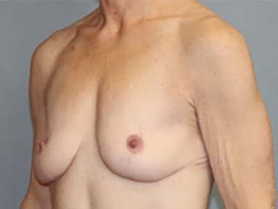 Breast Lift Before & After Image
