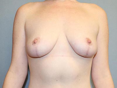 Breast Lift Before And After Patient 14