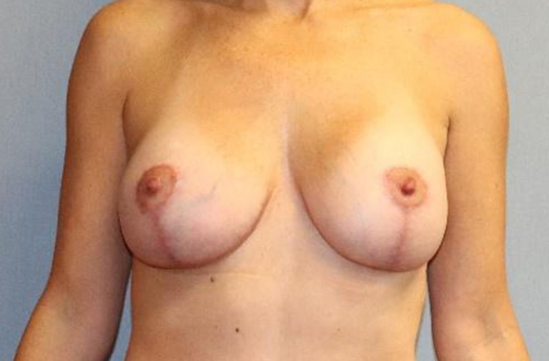 Breast Lift Before And After Photo