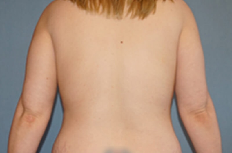 Breast Lift Before And After Photo