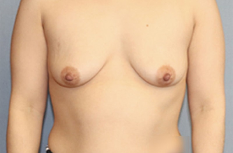 Breast Lift Before And After Photo